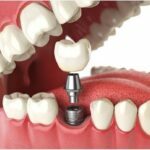 Several Reasons To Differentiate Between Dental Veneers And Dental Crowns Dental Veneers