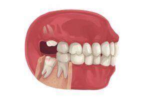 The Process of Extracting Wisdom Teeth Wisdom Teeth