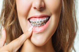 Which One is the Better Option to Straighten Your Crowded Teeth? Braces or Invisalign? Crowded Teeth